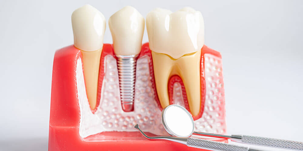 Dental Implants Thornhill