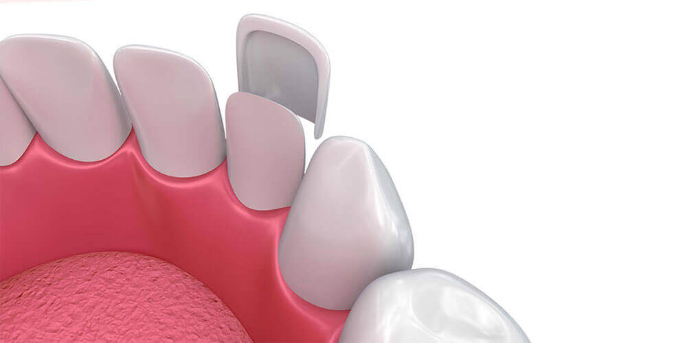 Dental Veneers Thornhill
