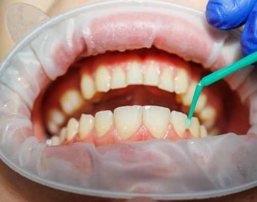 Periodontal exam and treatment planning at Promenade Village Dental